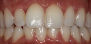  Après le traitement par gouttières Clearcorrect