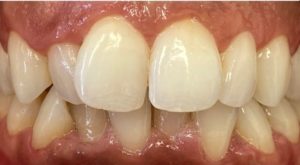  Avant le traitement par gouttières ClearCorrect