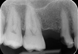  Avant la pose de l′implant