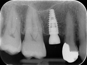  Implant posé avec vis de cicatrisation