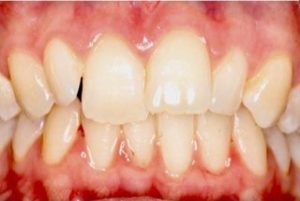  Avant le traitement par gouttières ClearCorrect