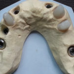 Cas complexe maxillaire supérieur avec 5 implants + 3 dents piliers naturelles
