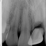 Fracture de la racine