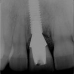 Implant Straumann et couronne céramique laboratoire Olivier Rey-Mermet