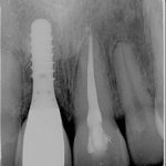 Implant maison Straumann Bâle, + couronne céramique laboratoire Olivier Rey-Mermet