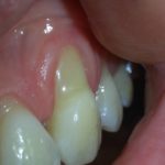 Sévère retrait gingival