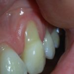 Sévère retrait gingival