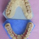 Travail soigneux sur modèles( laboratiore Rey-Mermet):doubles restaurations maxillaires complètes