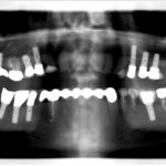 Implants pluriels, remplacement multiple par plusieurs implants sur 10 ans