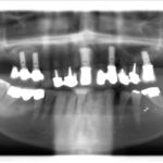 Plusieurs implants Straumann avec greffes bilatérales des sinus maxillaires (réalisées en 2001- radio 2010)