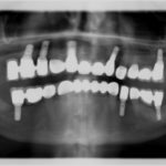Radiographie finale, 8 implants, 25 dents céramiques