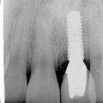 Radiographie implant + couronne céramique